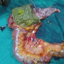 A case of Anemia with Cancer Colon