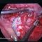 Misdiagnosis can lead to rupture of appendix
