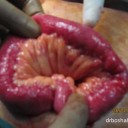 Intestinal Obstruction due to Stones