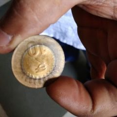 Rs 10 coin removed from abdomen