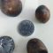 Huge Gallstone Removed