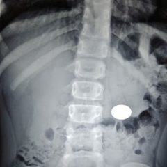 Child accidentally swallowed battery