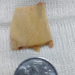 Endoscopic removal of Chicken bone