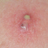Sebaceous Cyst: Causes, Diagnosis, and Treatment
