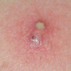 Sebaceous Cyst: Causes, Diagnosis, and Treatment
